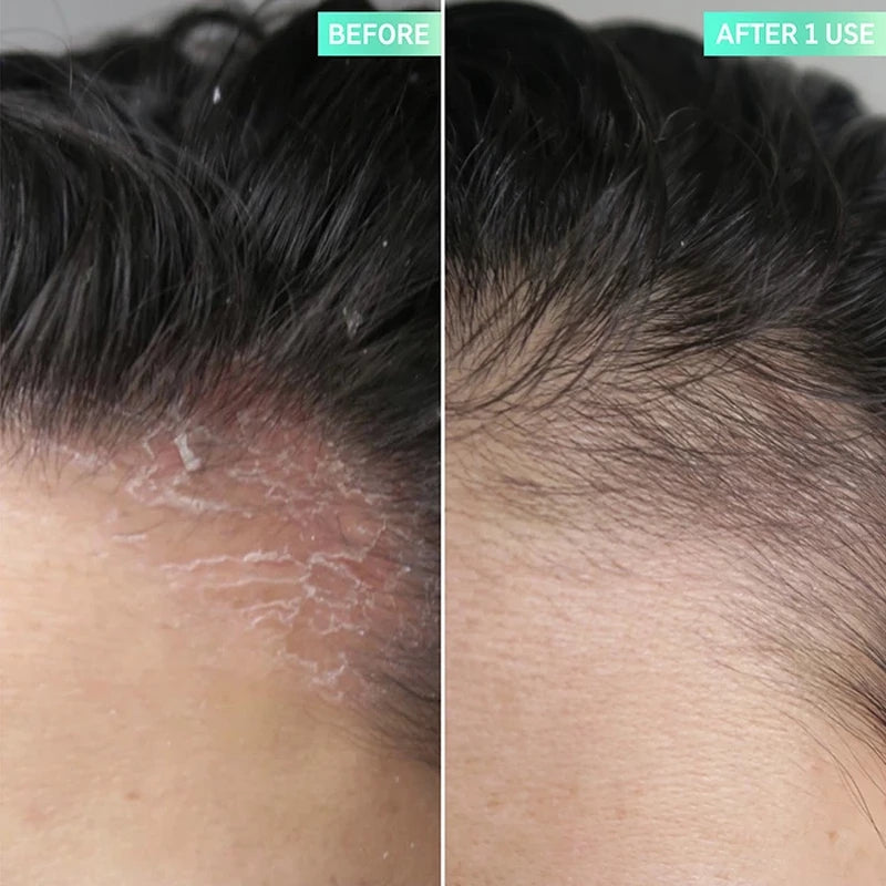 The Inkey List Salicylic Acid Exfoliating Scalp Treatment 150 Ml