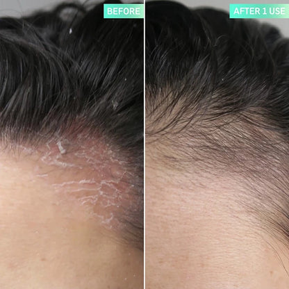  The Inkey List Salicylic Acid Exfoliating Scalp Treatment 150 Ml